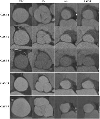 Case Report: Transcatheter aortic valve implantation using balloon-expandable bioprosthesis in patients with severe pure aortic regurgitation on noncalcified native valves: a series of cases